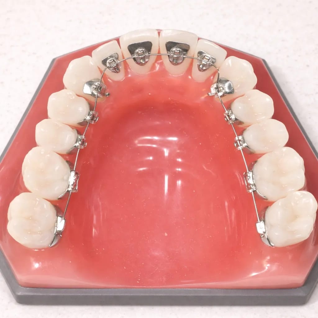 Lingual_orthodontics