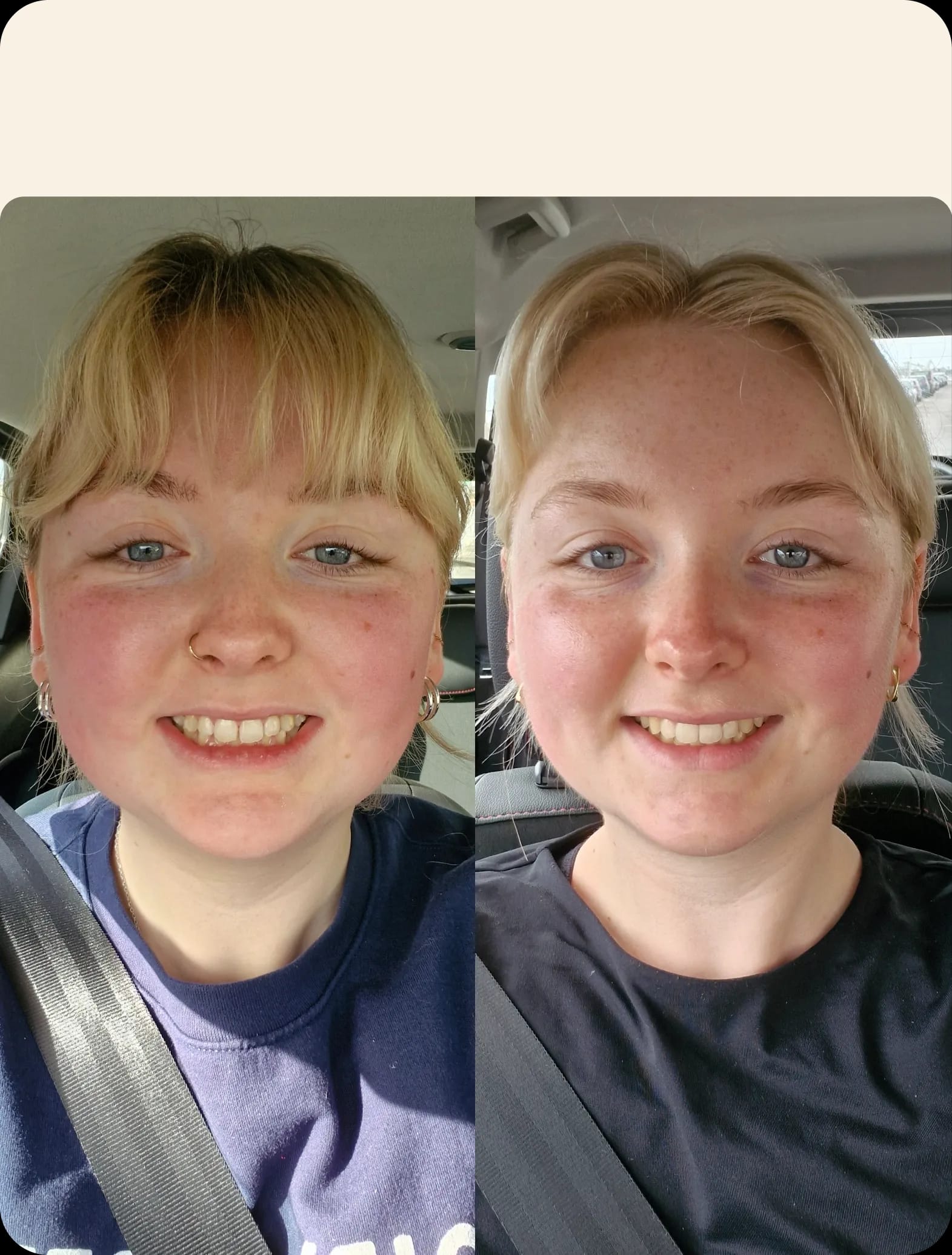IU before and after