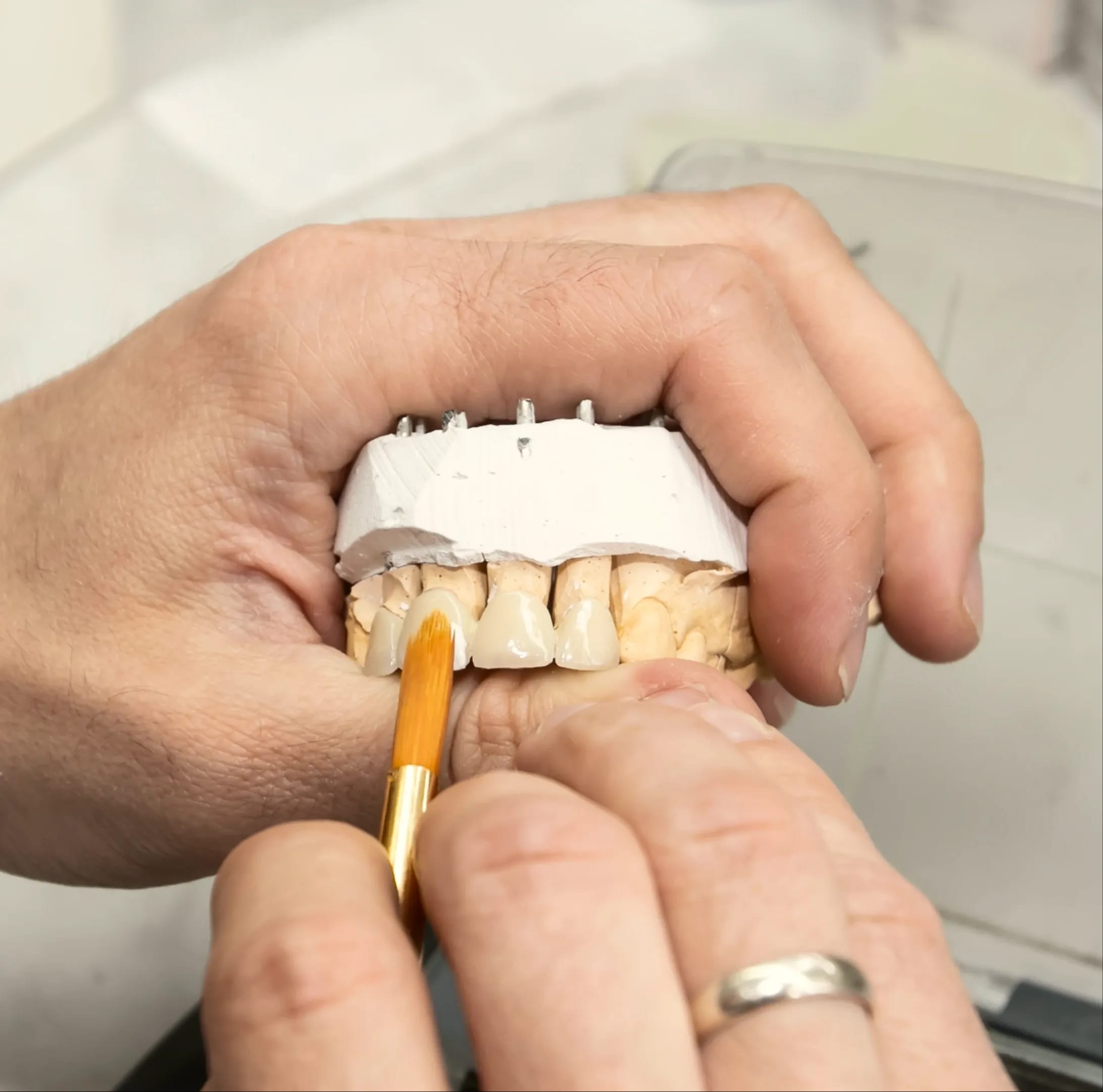 IU bespoke dental crown