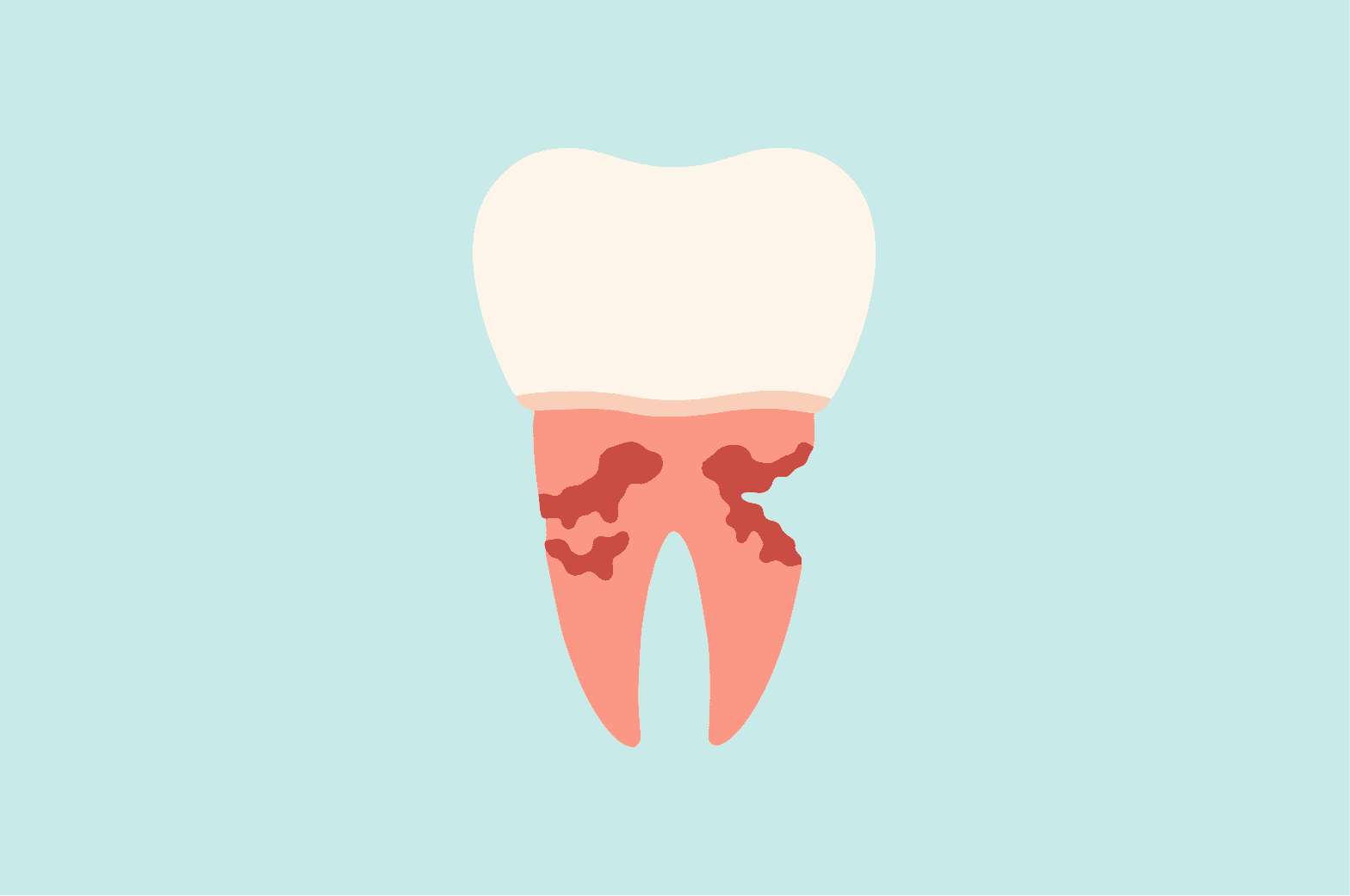 IU tooth decay