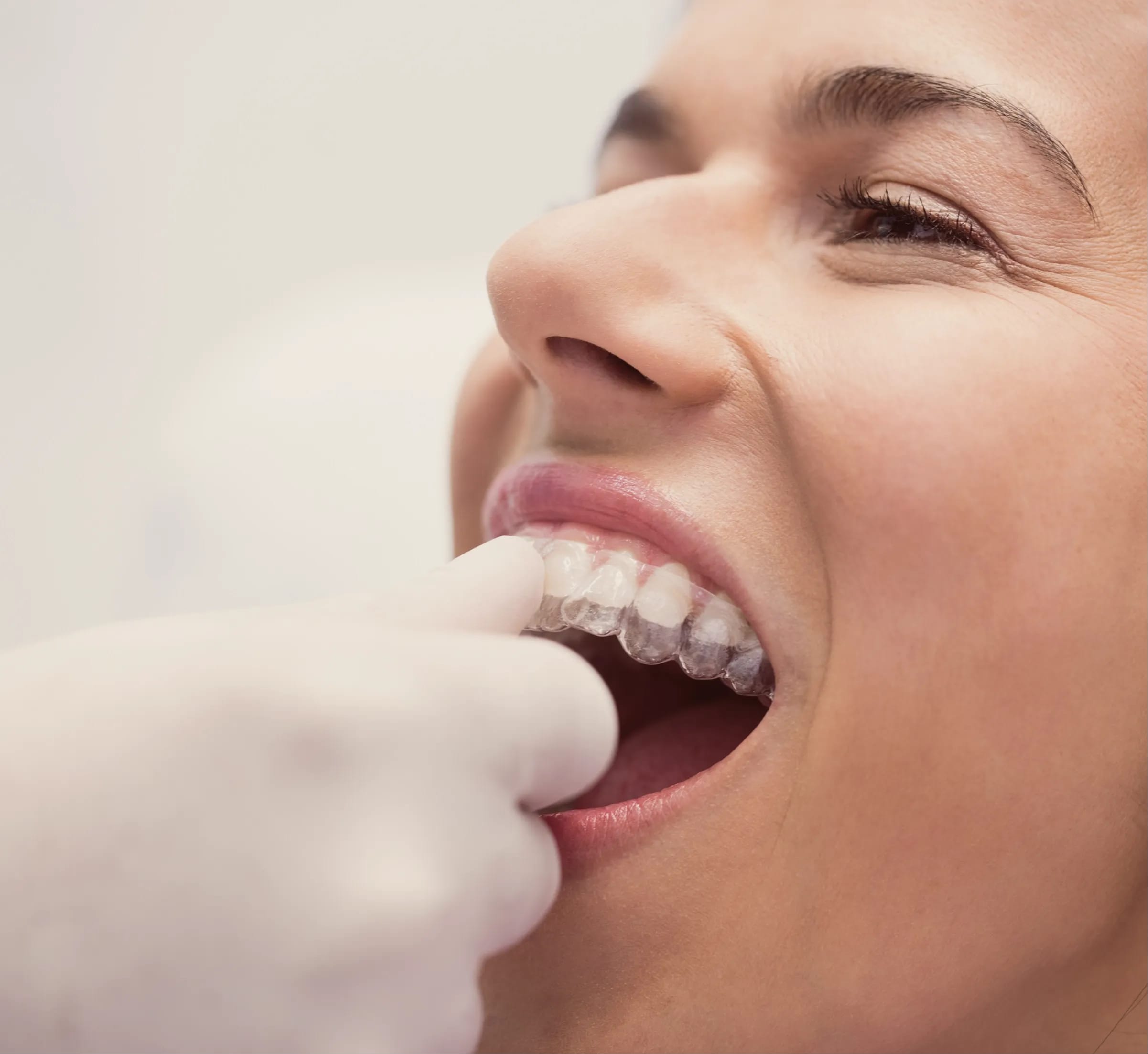 IU clear aligners step 3