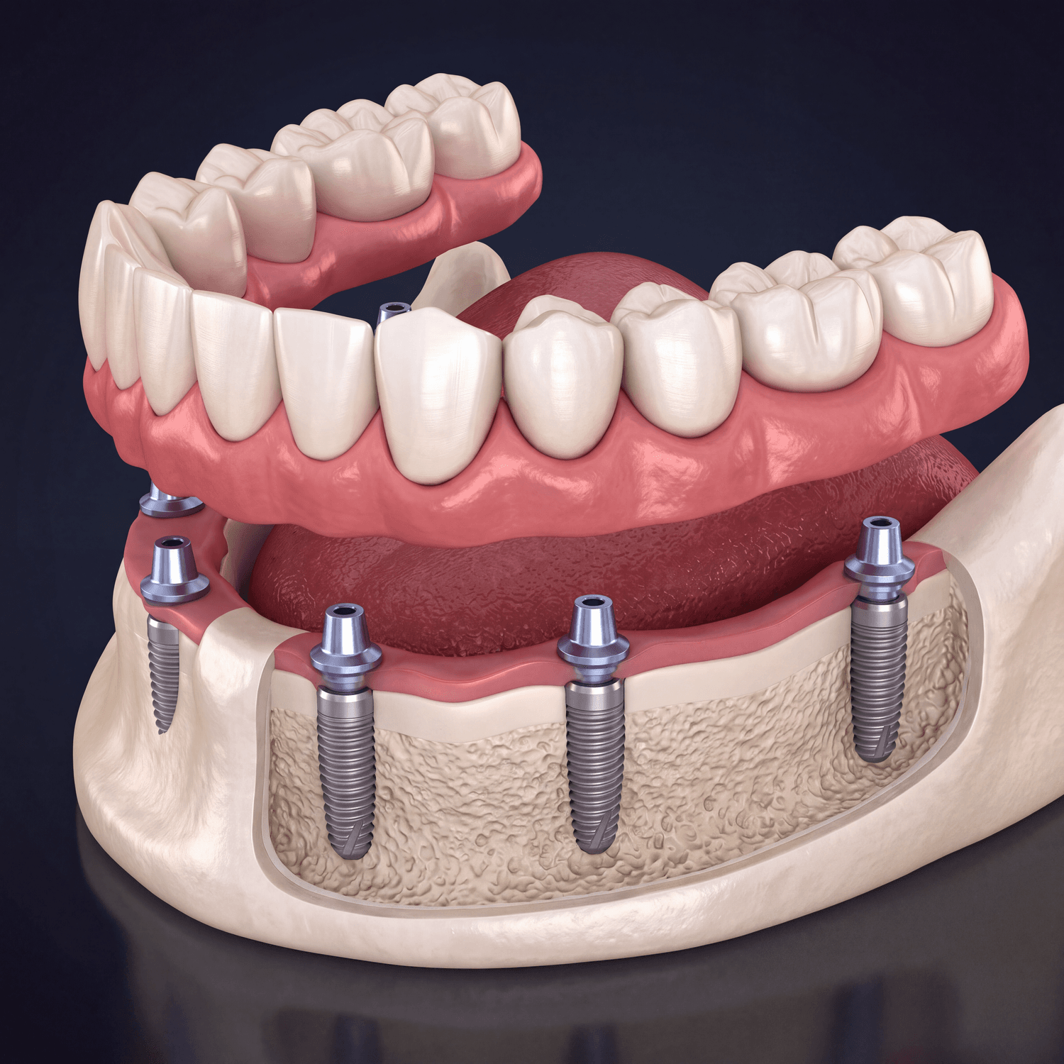 all on 6 dental implants